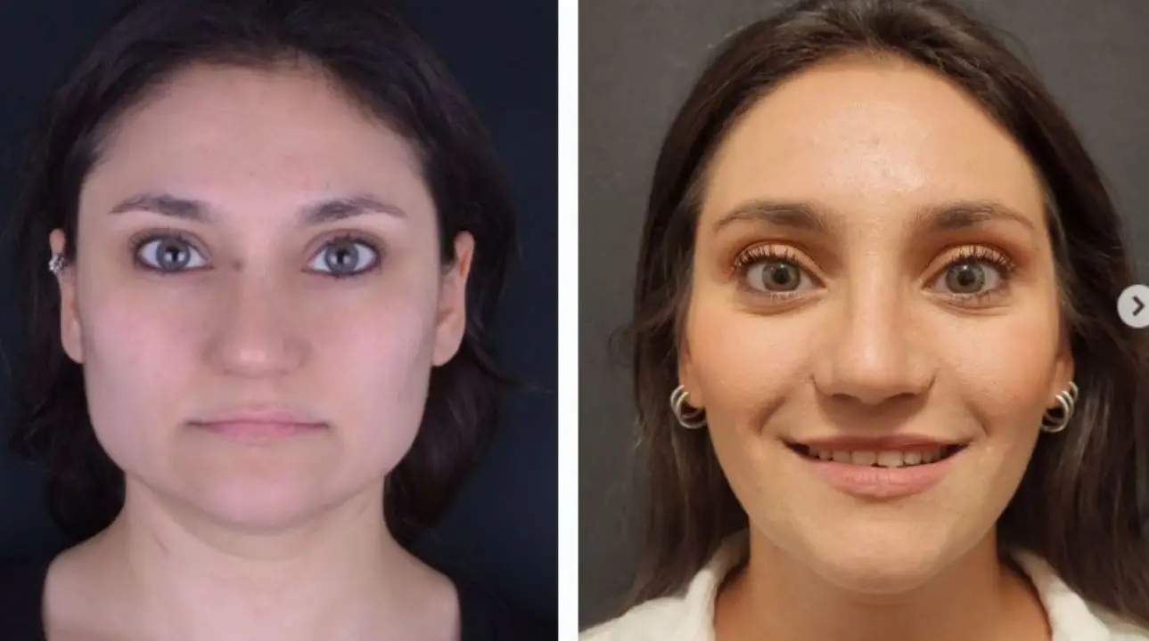 How Jawline Contouring Is Performed