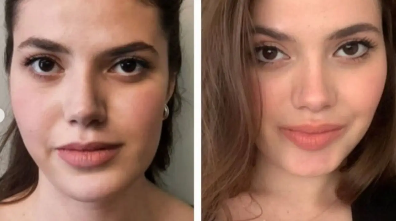 Planning Your Jawline Contouring Journey 