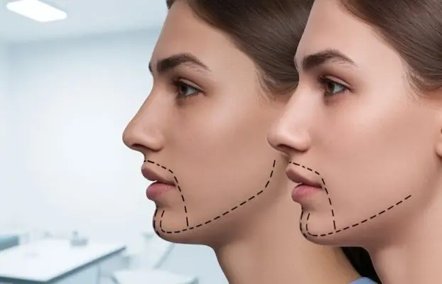 V-Line Surgery 2026 (Achieving a Slimmer, V-Shaped Face)
