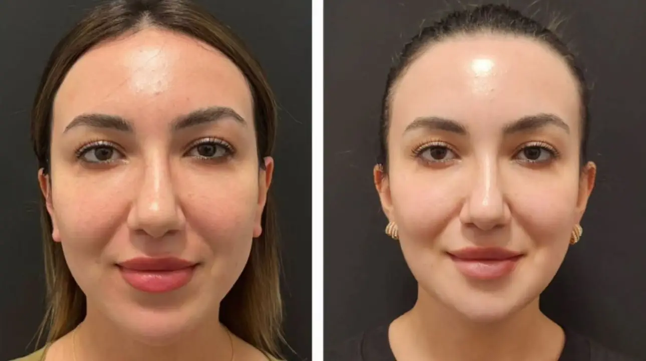 What to Expect After the Procedure?