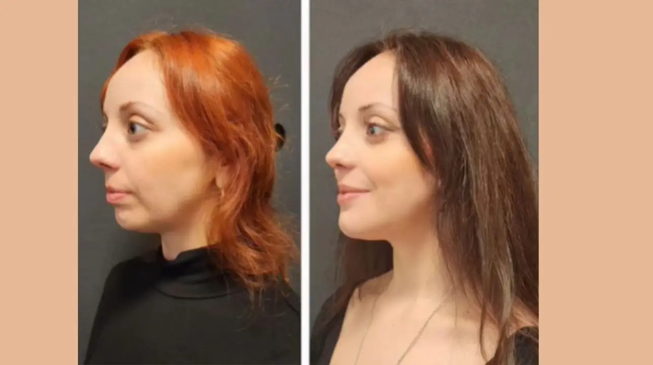 Who Is a Good Candidate for Jawline Contouring?