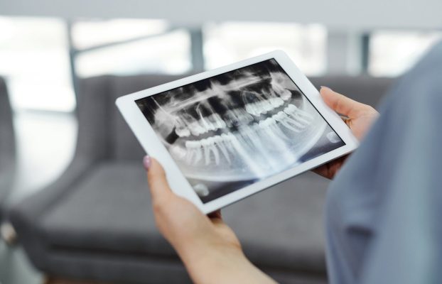 Zigomatik Ark Kırığı Tedavisi Nasıl Yapılır?