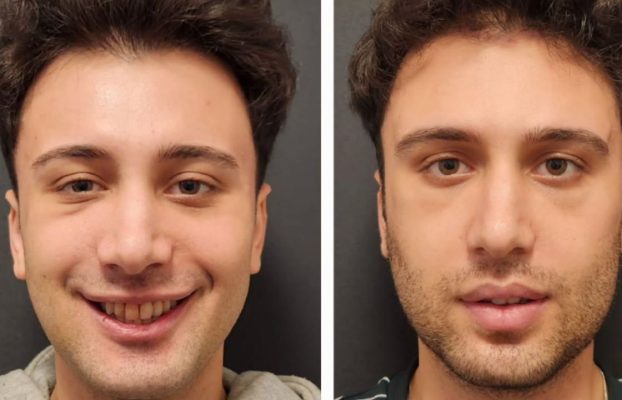 How Much Is Maxillofacial Surgery in Turkey?