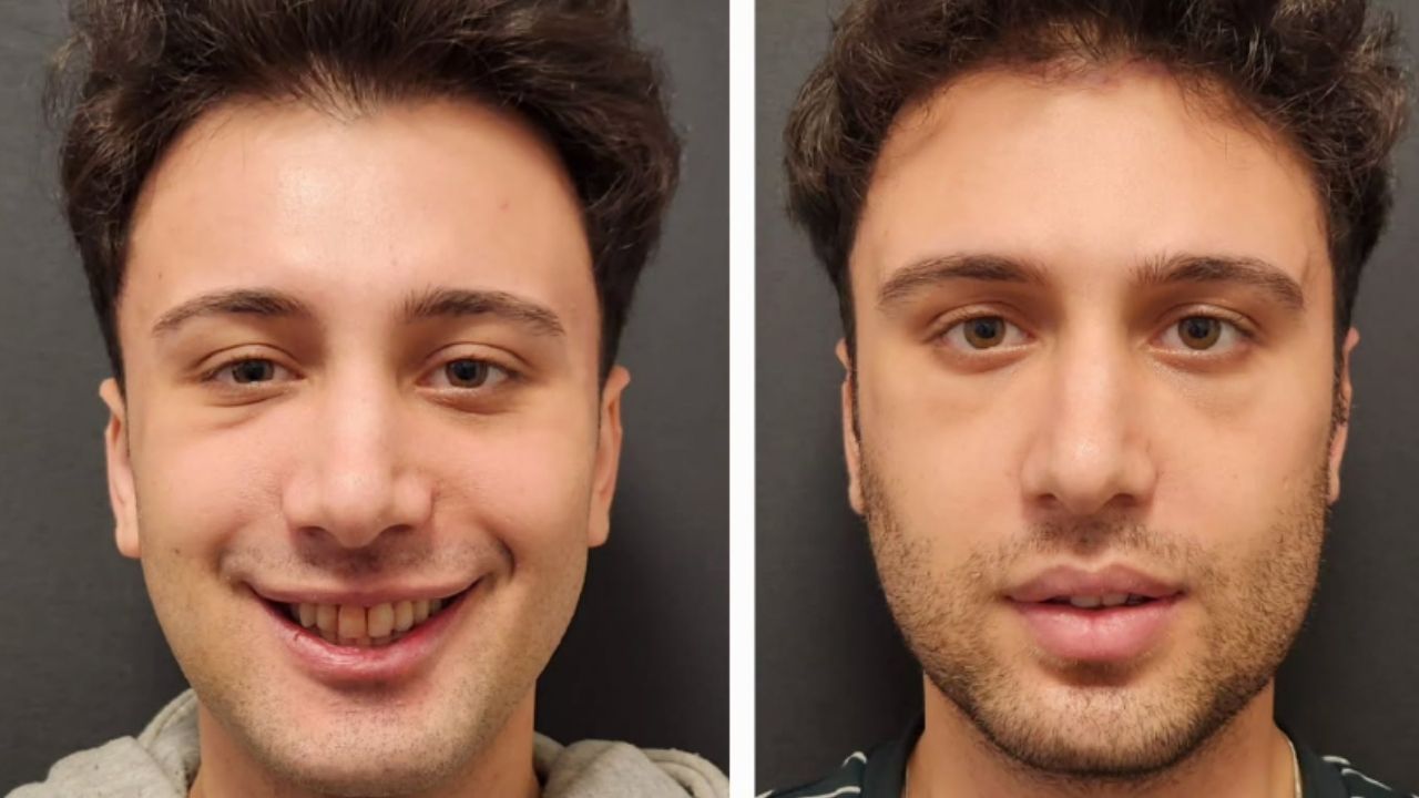 How Much Is Maxillofacial Surgery in Turkey?