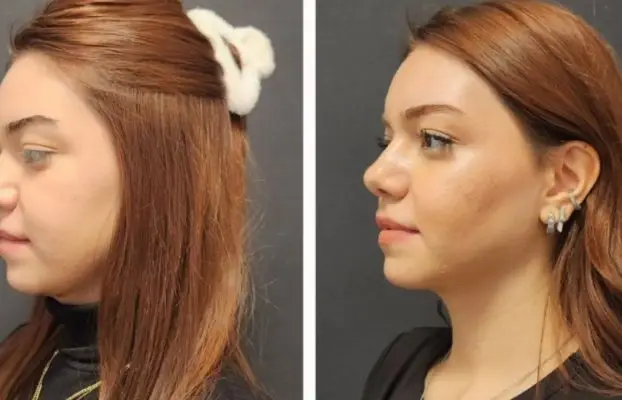 Jaw Injury (Symptoms, Types, Treatment and Recovery)