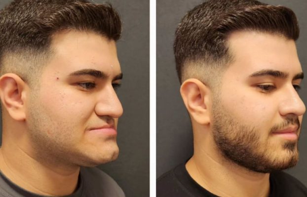 Jawline Filler Cost 2026 (Pricing, Factors & Treatment)