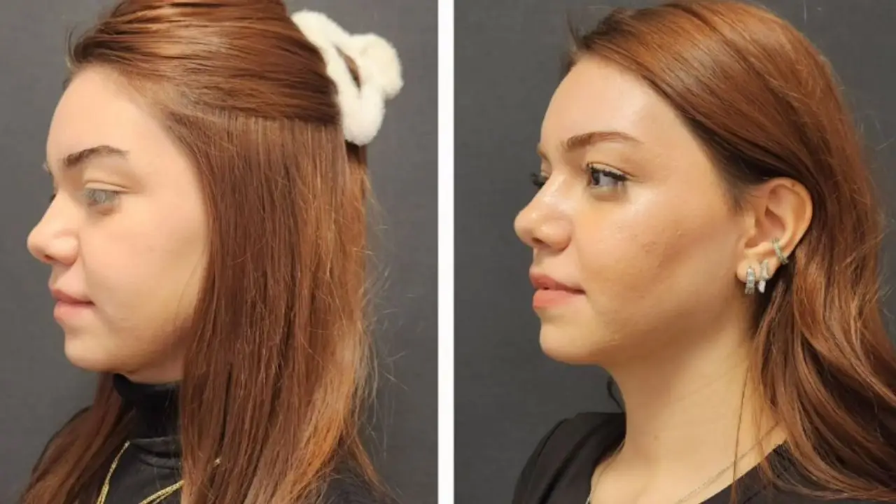 Recovery & Aftercare | How Much Is Maxillofacial Surgery in Turkey?